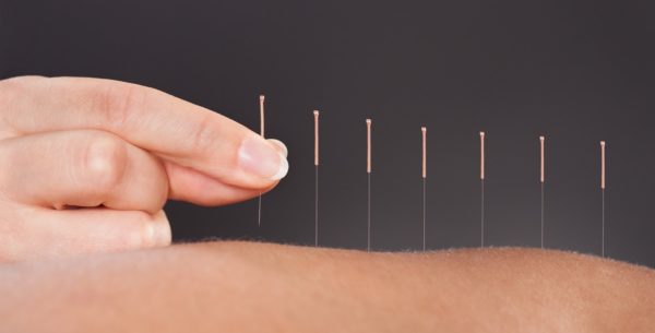 artroza tretmana akupunkture