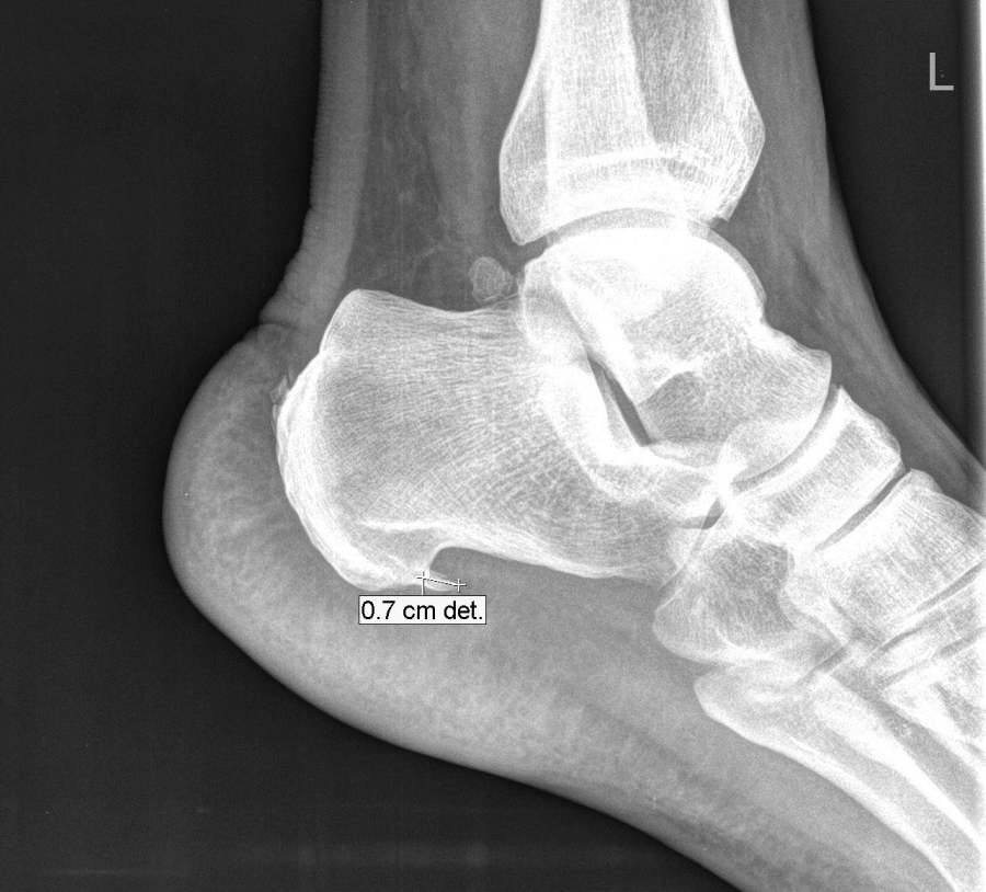 artroza kostiju tretman stopala bolovi u zglobovima nakon noćnog sna