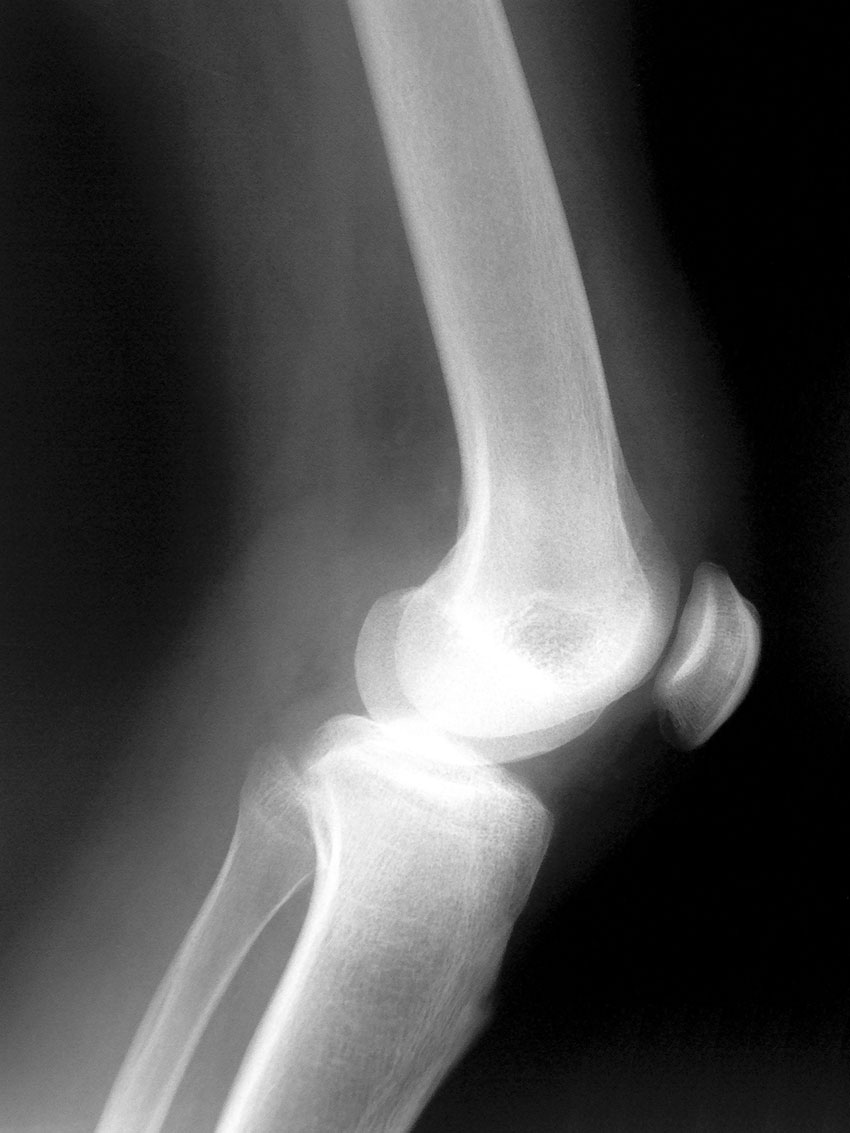 kako anestezirati bol kod artroze koljena
