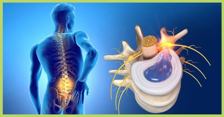 diskus-hernija